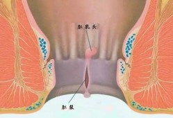肛裂能怀孕吗,孕期肛裂疼痛如何缓解疼痛
