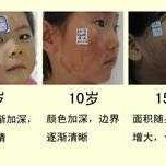 胎儿脸上胎记怎么预防（胎儿脸上胎记怎么预防遗传）