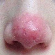 孕期红鼻头（鼻尖发红是什么原因）