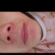 孕妇过敏对胎儿有影响吗（孕初期，嘴唇像过敏对胎儿有没有影响）