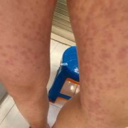 孕期腿上湿疹怎么办（腿上长满了湿疹，奇痒无比，怎么办啊）