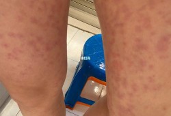 孕期腿上湿疹怎么办（腿上长满了湿疹，奇痒无比，怎么办啊）