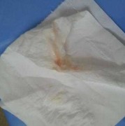 怀孕期间阴道出血（怀孕期间出血是什么情况）