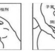 霉菌性阴道炎怀孕了怎么办,霉菌自愈的最佳方法