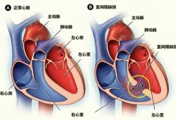 胎儿肺动脉狭窄（胎儿肺动脉狭窄能不能要）