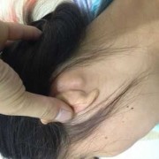 胎儿后颈部（宝宝切除扁桃体后耳朵下淋巴结肿大）