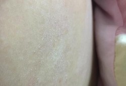 孕期肚皮干燥起皮图片（孕期肚皮干燥起皮图片大全）