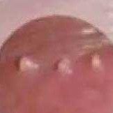 孕期外阴囊肿