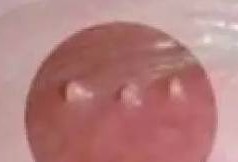 孕期外阴囊肿
