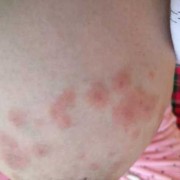 孕期乳房湿疹怎么治疗（乳房湿疹结痂破皮该怎么办）
