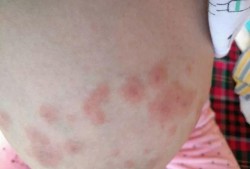 孕期乳房湿疹怎么治疗（乳房湿疹结痂破皮该怎么办）