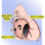 胎儿室间隔缺损2mm严重吗（新生儿房间隔缺损2mm能自愈吗）