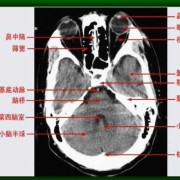 正常成人大脑中存在帆腔吗,胎儿大脑中帆腔怎么办