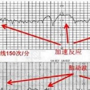 胎儿心率140次/分正常吗,胎儿心率140是男孩还是女孩