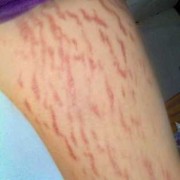 孕期肥胖纹（孕期肥胖纹会自己消吗）