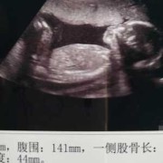 4个月胎儿图片（宝贝四个多月了，缺乏维生素D，要怎么补啊）