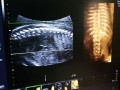 胎儿脊柱排列整齐（17周胎儿脊柱显示不清）