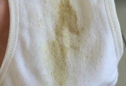 孕妇白带发黄什么原因,孕期皮肤变黄是什么原因