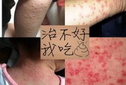 孕期皮炎图片大全（孕妇得了湿疹用什么药？孕妇身上长湿疹会对胎儿有影响吗）