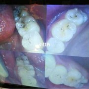 孕妇能补牙齿吗,孕期能不能补牙洞