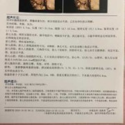 四维胎儿不配合（四维胎儿不配合）
