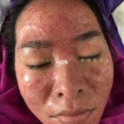孕期激素脸（孕期激素脸爆发怎么处理）