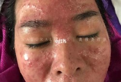 孕期激素脸（孕期激素脸爆发怎么处理）
