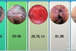 尖锐湿疣对胎儿影响吗（得了尖锐湿疣怀孕可以吗）