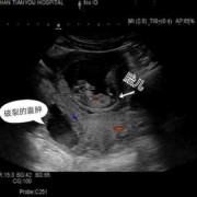 孕期附件囊肿（做b超能把怀孕看成附件囊肿吗）