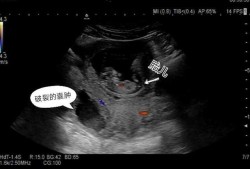 孕期附件囊肿（做b超能把怀孕看成附件囊肿吗）