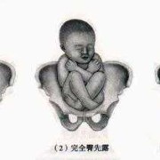 胎儿臀先露（一岁以内的宝宝要不要露屁股）
