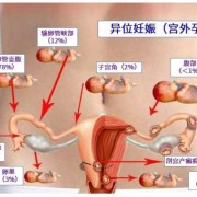 宫外孕胎儿（宫外孕胎儿能存活多久）