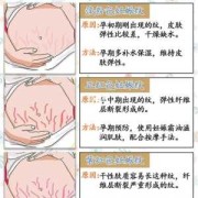 怎样消除妊娠纹,孕期长妊娠纹怎么消除最快