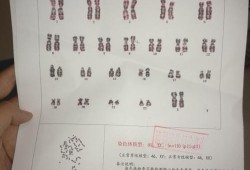 孕妇检查染色体过高有什么问题,胎儿染色体多一条是什么原因造成的
