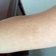 怀孕期间妊娠纹痒怎么办（怀孕期间妊娠纹痒怎么办呢）