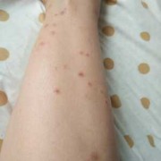 孕妇为什么会得湿疹,孕期湿疹止痒最有效的方法