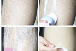 孕妇可以激光脱毛吗,孕期用了脱毛膏怎么办啊