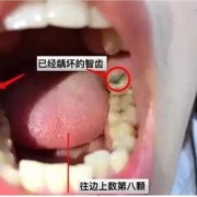 智齿痛对胎儿（智齿痛对胎儿有影响么?）
