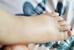 怎样缓解孕期脚肿（怀孕了腿脚肿怎么办）