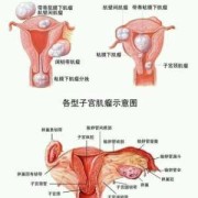 子宫肌瘤影响胎儿吗（孕妇子宫肌瘤影响胎儿吗）
