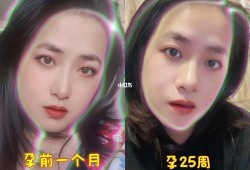 怀孕后发现鼻子变大，生完宝宝后会不会变小,孕期鼻子变大产后会恢复吗