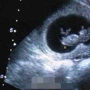 怀孕18周时B超显示孩子腿短怎么办,18周胎儿头围标准表图片