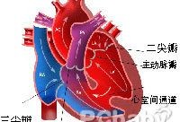 胎儿室缺大（胎儿室缺大）