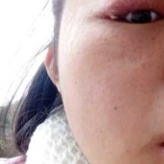 孕期眼睛疼（孕妇眼睛发炎怎么办）