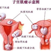 子宫肌瘤对胎儿的影响（子宫肌瘤对胎儿的影响大吗）
