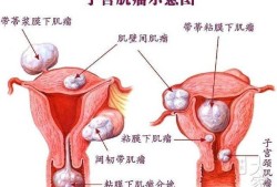 子宫肌瘤对胎儿的影响（子宫肌瘤对胎儿的影响大吗）