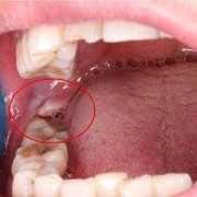 孕妇得了智齿冠周炎，该如何治疗,孕期智齿发炎肿痛怎么缓解