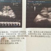 孕18周胎心153一定是女孩吗,胎心音辨别胎儿男女马蹄声