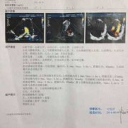 胎儿肺动脉与主动脉内径比例偏小是什么意思,胎儿主肺动脉比例异常的原因没事吧
