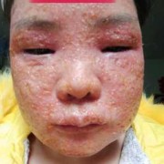 孕期激素脸（孕期激素脸爆发怎么处理）